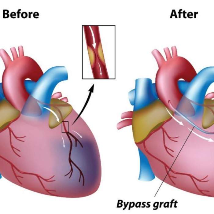Koroner arter bypass, otojen greft, Safen ven veya İMA vb. üç koroner