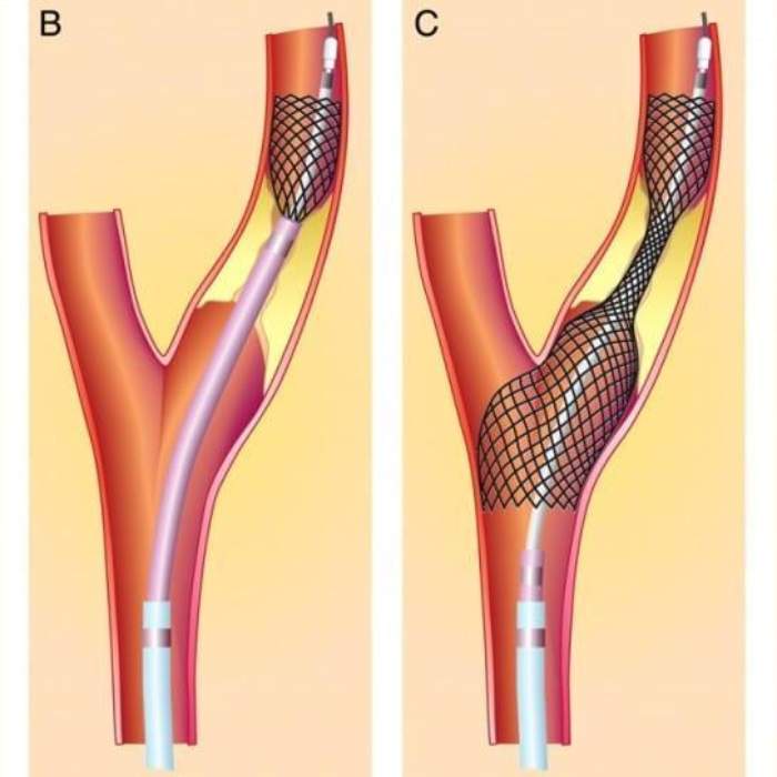 Koroner arter bypass grefti, karotis endarterektomi ve yama plasti
