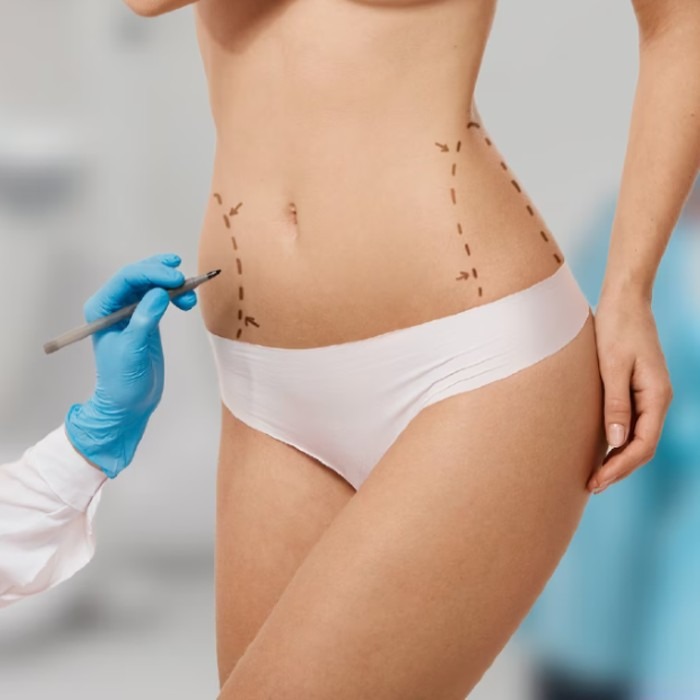 Liposuction