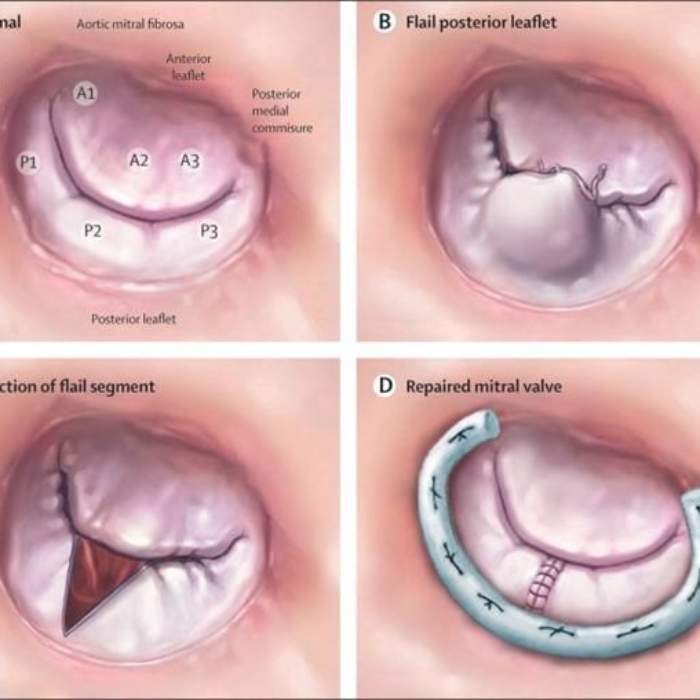 Protez halkalı, kardiyopulmoner bypasslı, protezli mitral kapak onarımı