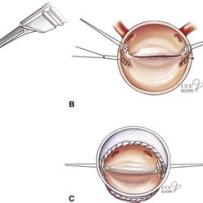 Kardiyopulmoner bypass ile ön kapak onarım teknikleriyle mitral kapak onarımı