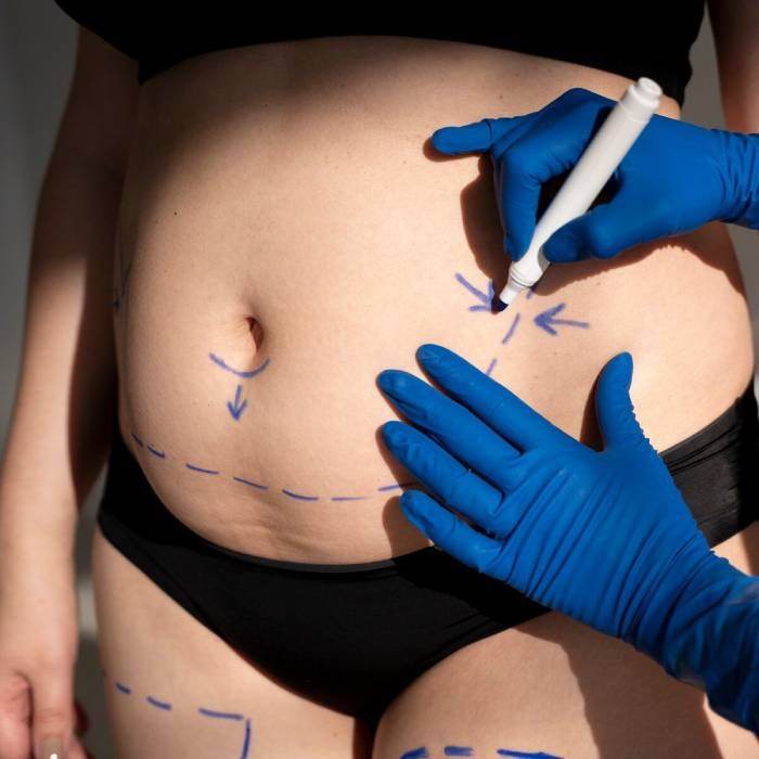 Tummy Tuck