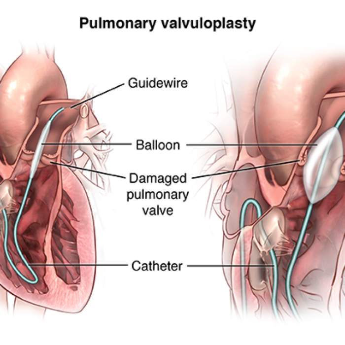 Valvuloplasti, aort kapağı, açık, kardiyopulmoner bypass ile